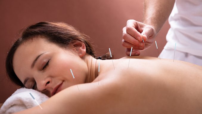 Woman getting an acupuncture and IVF service