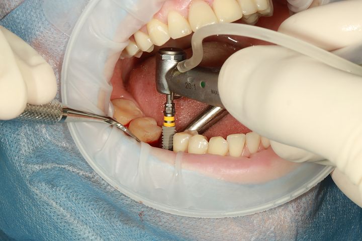 full mouth dental implants offer